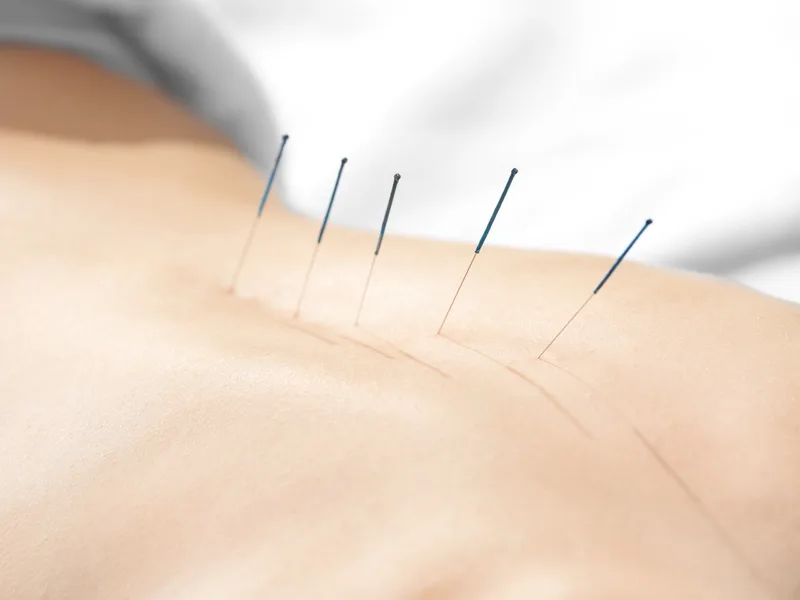 Acupuncture at Prairie Star Chiropractic in Hudsonville