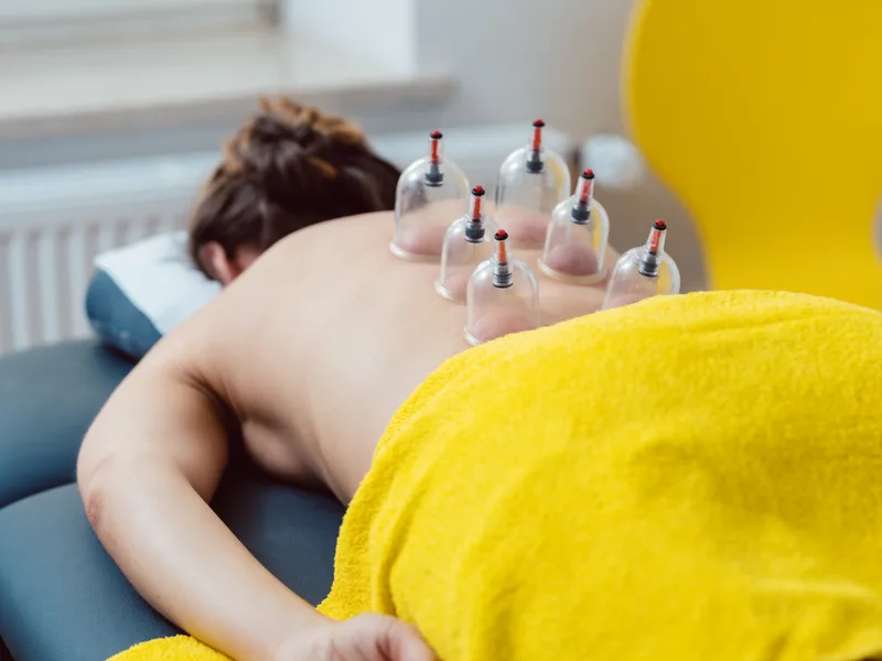 Cupping Therapy at Prairie Star Chiropractic in Hudsonville