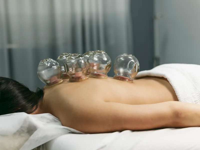 Cupping Therapy at Prairie Star Chiropractic in Hudsonville