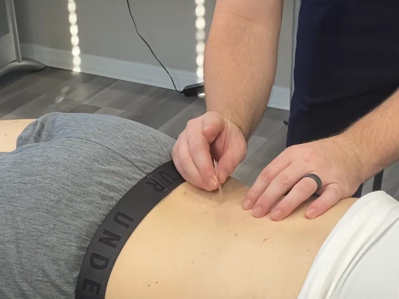 How Dry Needling works at Prairie Star Chiropractic