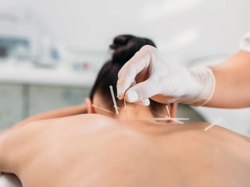 Dry Needling at Prairie Star Chiropractic in Hudsonville
